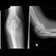 Monteggia fracture of proximal ulna and head of radius, type II: X-ray - Plain radiograph